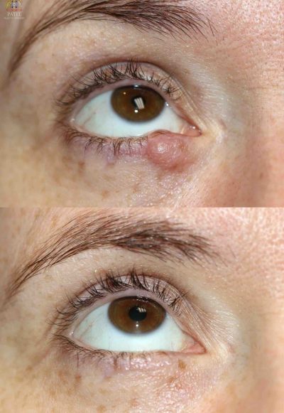 Eyelid lesion removal without scarring by Dr. BCK Patel MD, of Salt Lake City and St. George, Utah